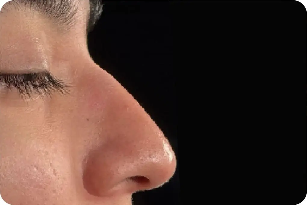 Rinoplastia - Antes