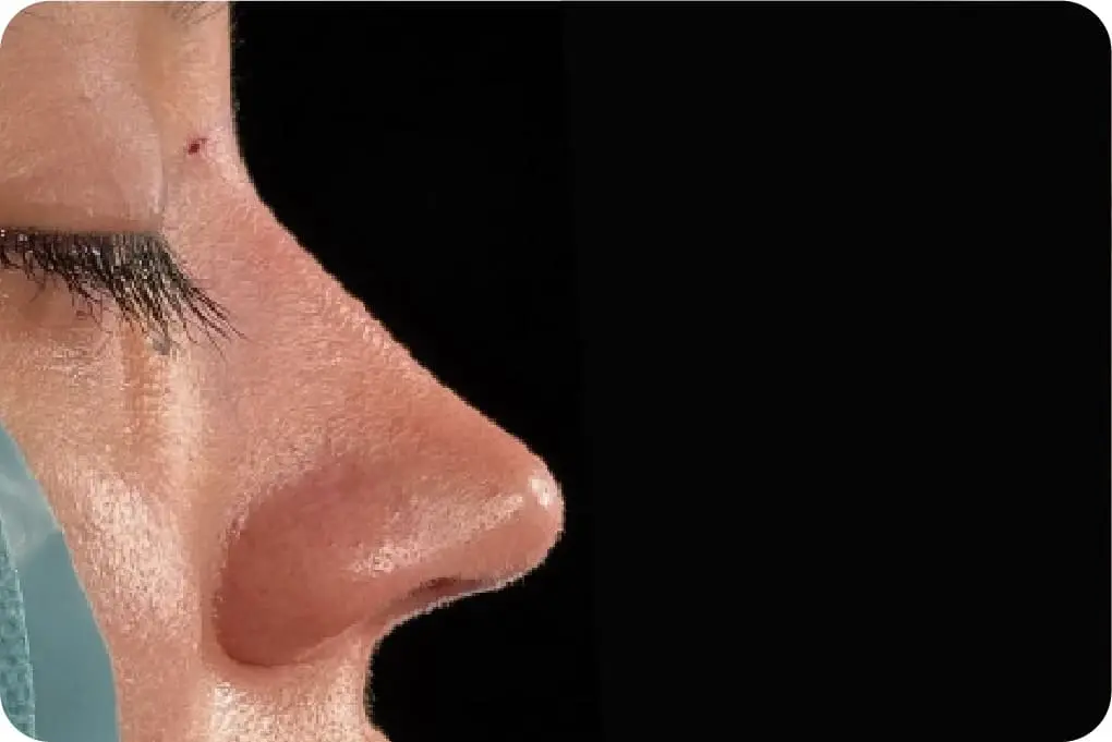 Rinoplastia - Después