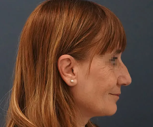 Rinoplastia. Caso A - Antes.