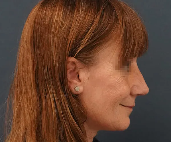 Rinoplastia. Caso A - Después.