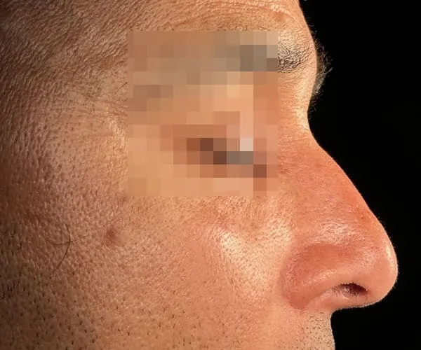 Rinoplastia. Caso B - Antes.