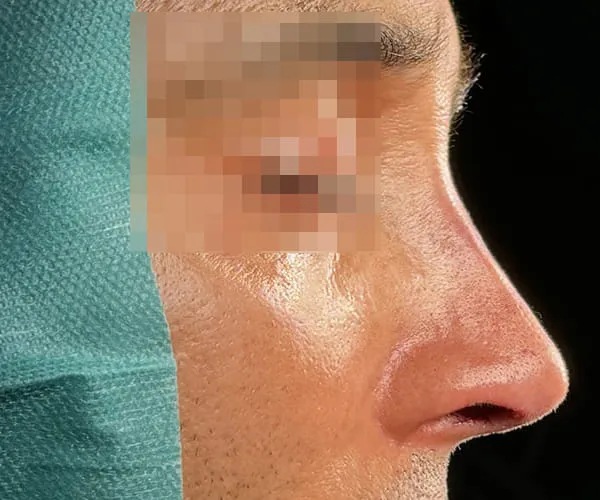 Rinoplastia. Caso B - Después.
