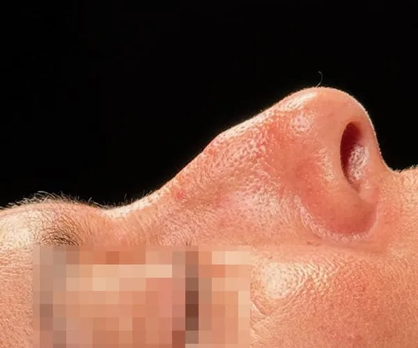 Rinoplastia. Caso C - Antes.
