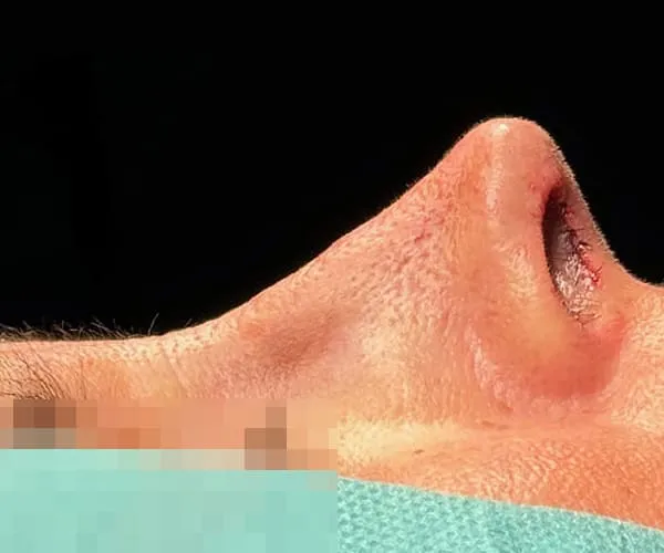 Rinoplastia. Caso C - Después.