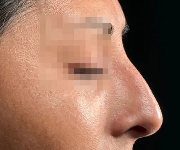 Rinoplastia. Caso D - Antes.