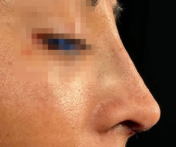 Rinoplastia. Caso D - Después.