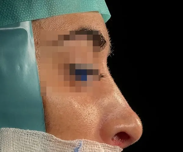 Rinoplastia. Caso E - Antes.