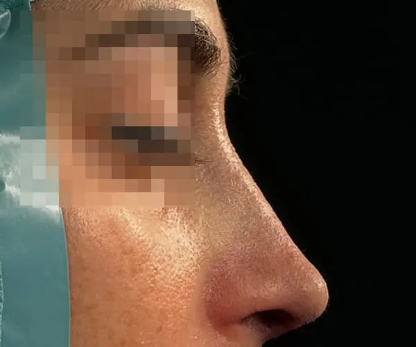 Rinoplastia. Caso E - Después.