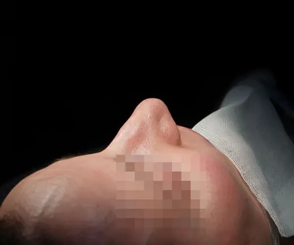 Rinoplastia. Caso F - Antes.
