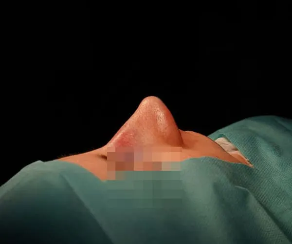 Rinoplastia. Caso F - Después.