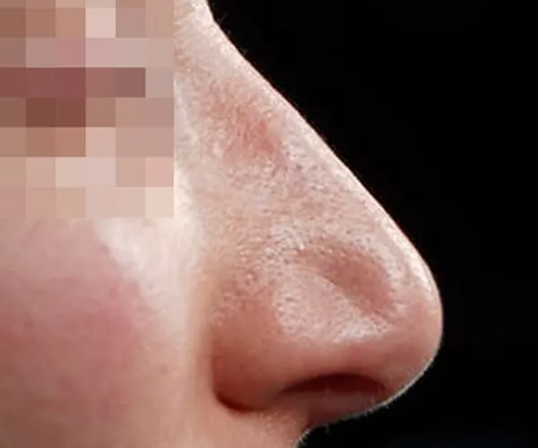 Rinoplastia. Caso G - Antes.