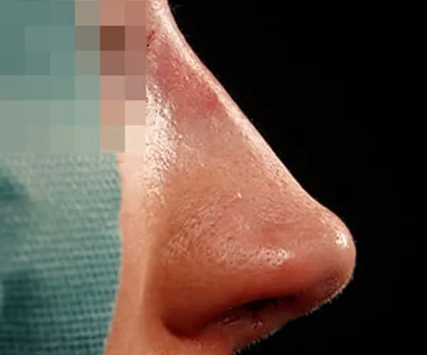 Rinoplastia. Caso G - Después.