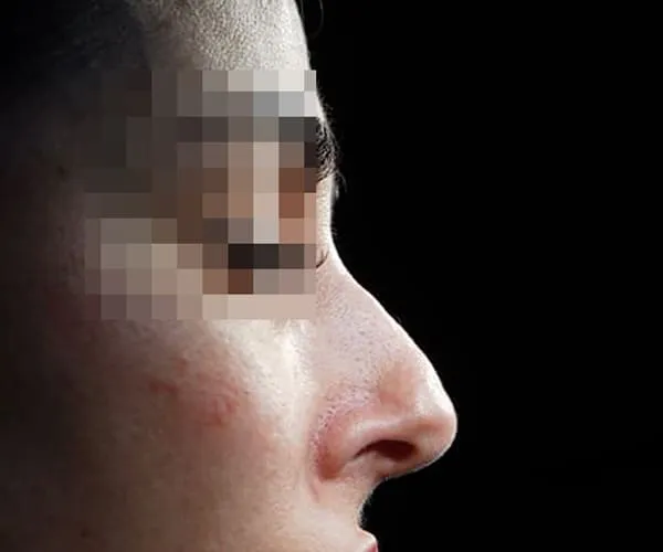 Rinoplastia. Caso H - Antes.