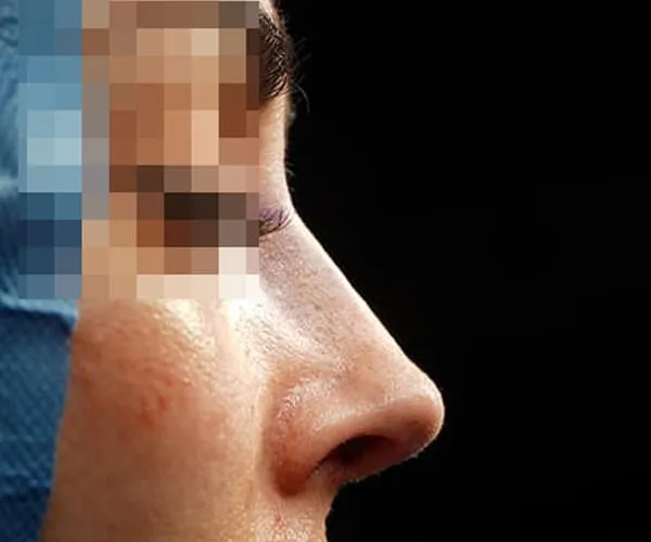 Rinoplastia. Caso H - Después.
