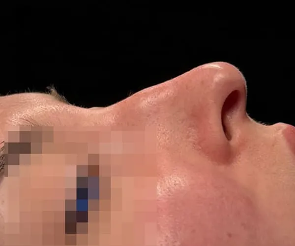 Rinoplastia. Caso I - Antes.