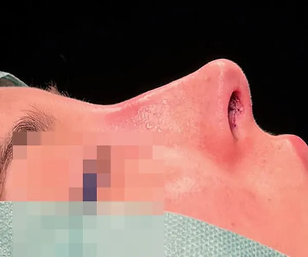 Rinoplastia. Caso I - Después.