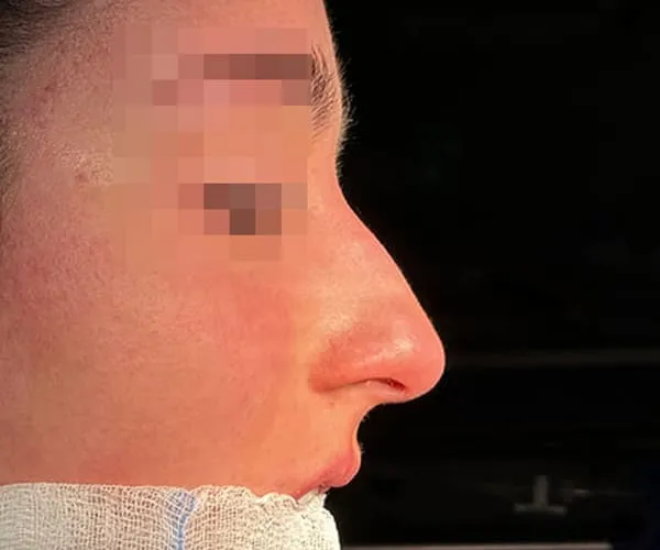 Rinoplastia. Caso J - Antes.