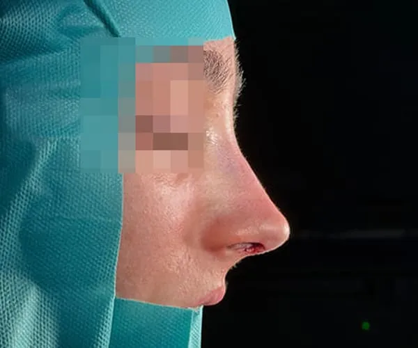 Rinoplastia. Caso J - Después.