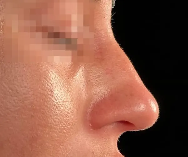 Rinoplastia. Caso K - Antes.