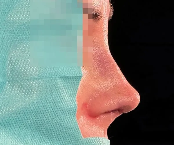 Rinoplastia. Caso K - Después.