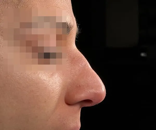 Rinoplastia. Caso L - Antes.