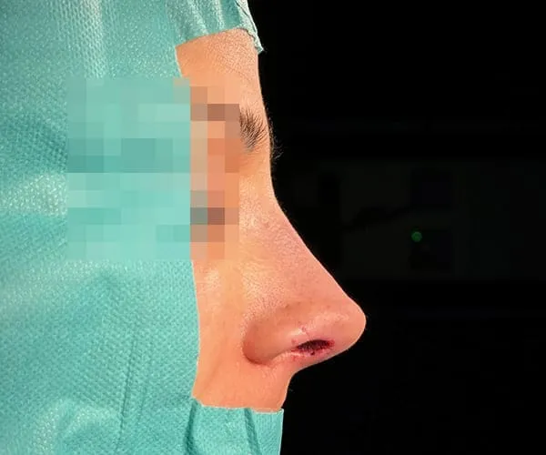 Rinoplastia. Caso L - Después.