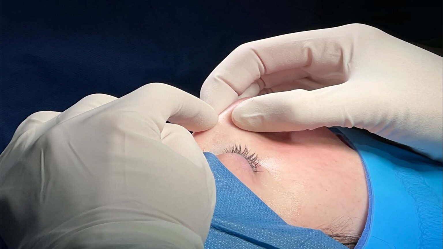 correcciones nasales paciente del doctor sarria | rinoplastia cerrada