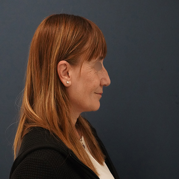 testimonio real 1a rinoplastia del dr sarria | rinoplastia antes y despues