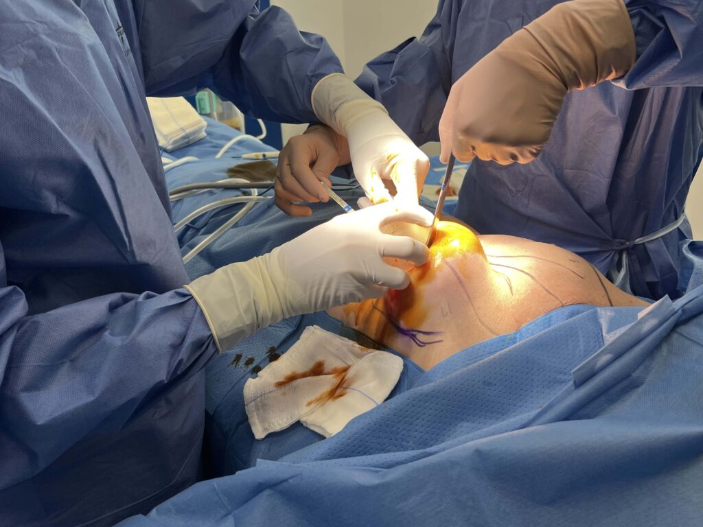 Colocacion del implante mamario | mastopexia con implantes