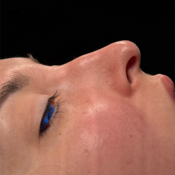 paciente rinoplastia antes y despues con el doctor sarria | rinoplastia antes y despues