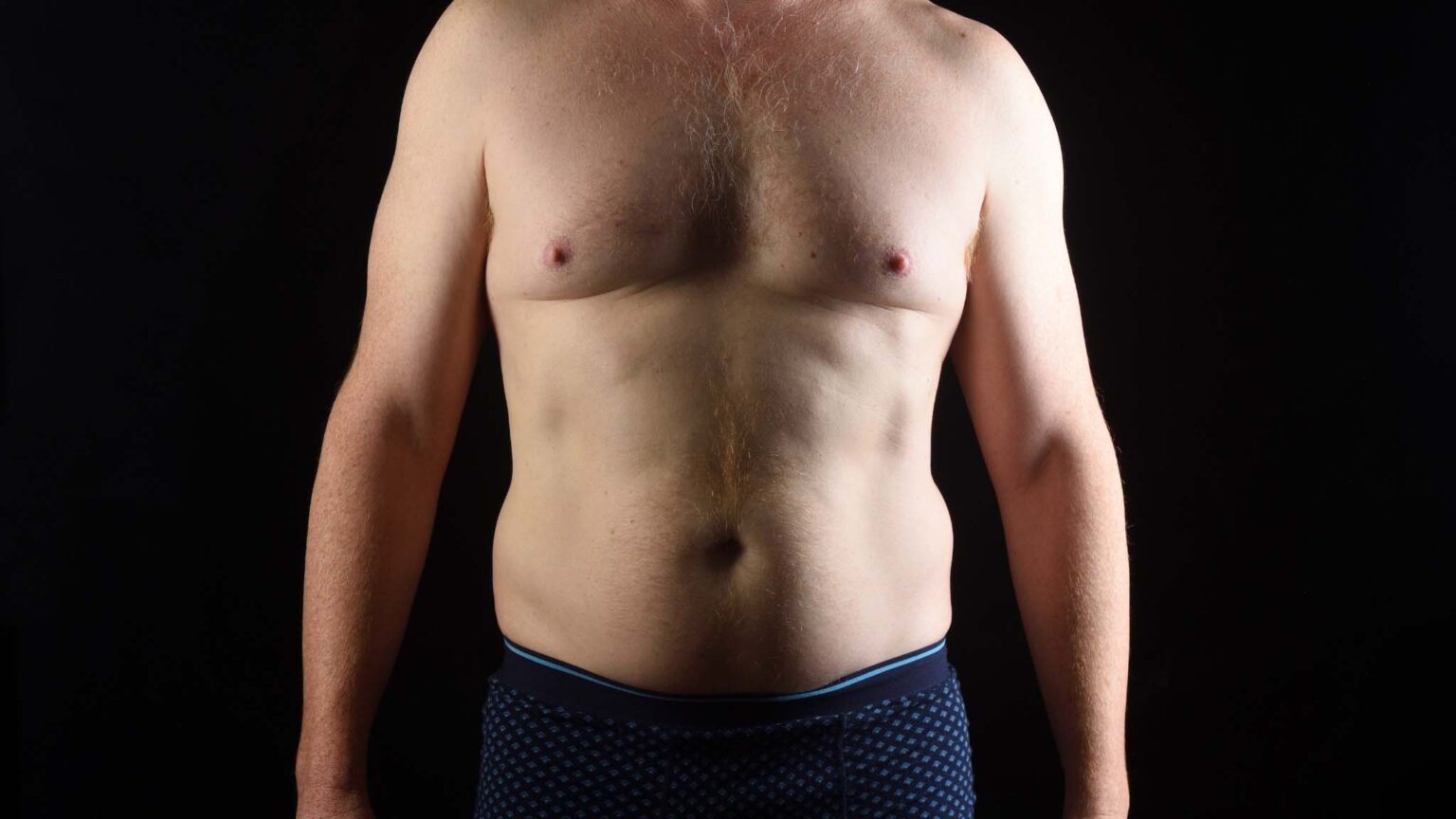 Tratamientos para cancer de prostata | ginecomastia