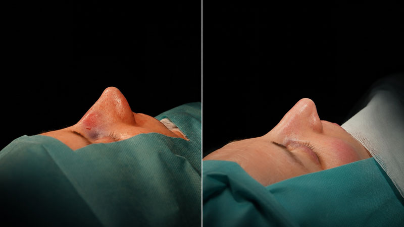 rinoplastia operar en cataluña | rinoplastia en barcelona testimonio