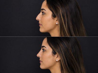 cuando se aprecia el resultado definitivo de una rinoplastia | rinoplastia en barcelona testimonio del dr sarria