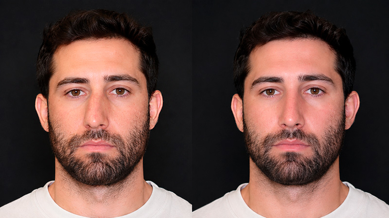 equilibrio estetico en rinoplastia | tabique desviado