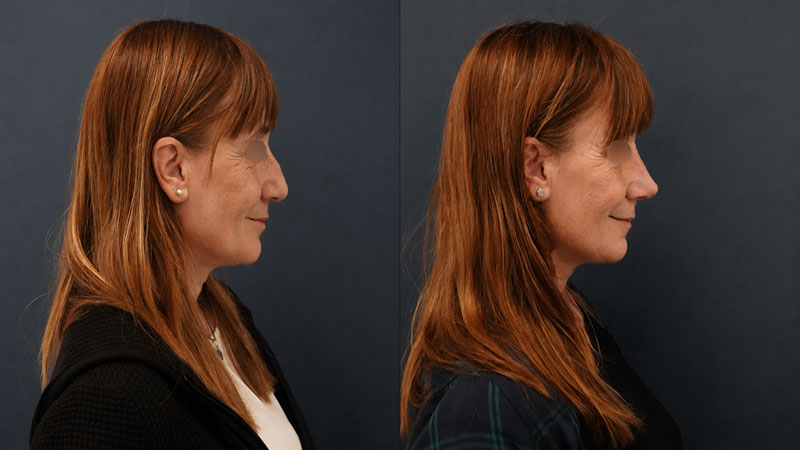 rinoplastia fina con resultados naturales y duraderos en barcelona | rinoseptoplastia